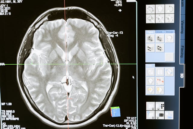 What are the Risk Factors for Cerebral Palsy?